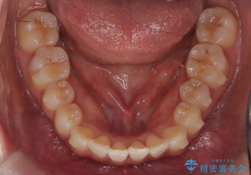 前歯のガタつきをマウスピース矯正で改善の治療中