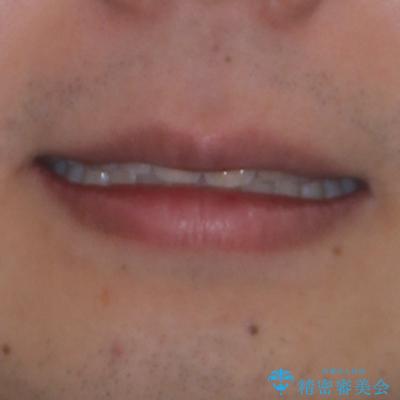 上顎前突とディープバイト ワイヤー矯正での確実に仕上げるの治療後(顔貌)