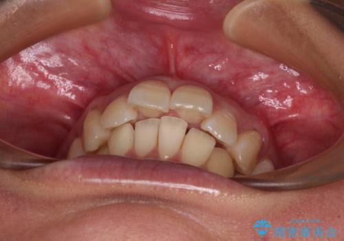 前に飛び出した上顎前歯をスッキリと引っ込める ワイヤー装置での矯正治療の治療前