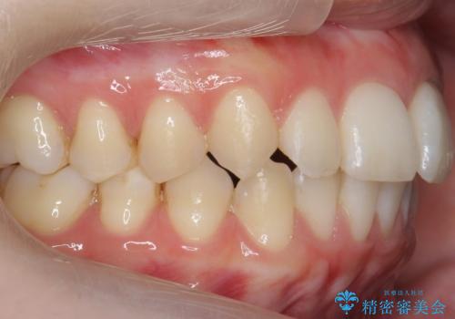 歯の着色を落としたいの治療後