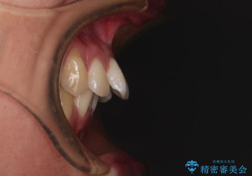 前に飛び出した上顎前歯をスッキリと引っ込める ワイヤー装置での矯正治療の治療前