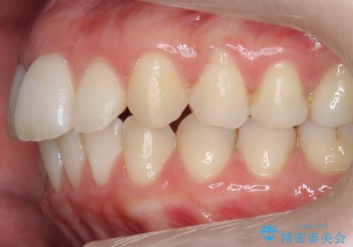 歯の着色を落としたいの治療後