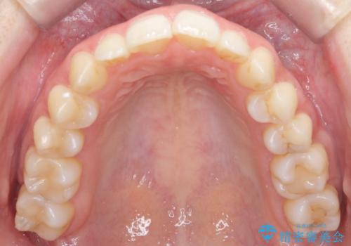 歯の着色を落としたいの治療後