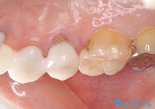 歯が折れている(1DAY インプラント)の治療前