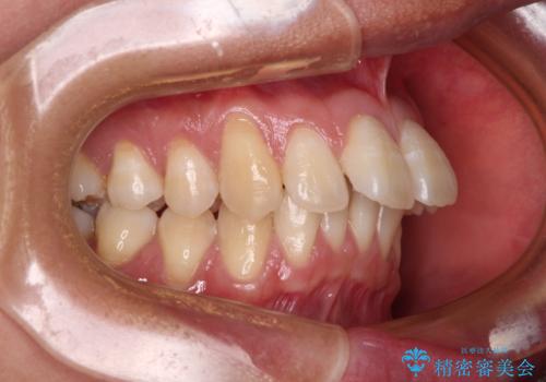 前に飛び出した上顎前歯をスッキリと引っ込める ワイヤー装置での矯正治療の治療前