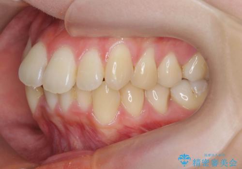 前歯のがたつきをマウスピース矯正できれいに!の治療前