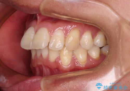 前に飛び出した上顎前歯をスッキリと引っ込める ワイヤー装置での矯正治療の治療前