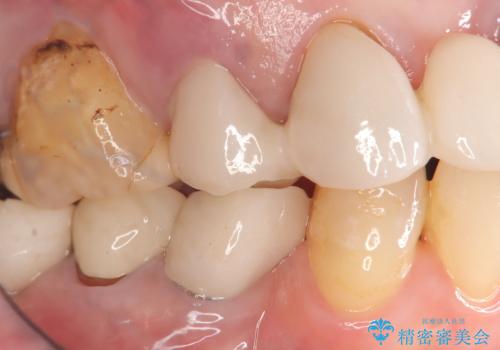 歯が折れている(1DAY インプラント)の症例 治療前