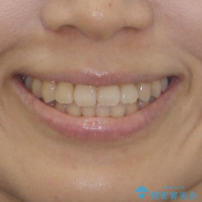 クロスバイトの前歯を改善 ワイヤー装置で楽々矯正治療の治療後(顔貌)