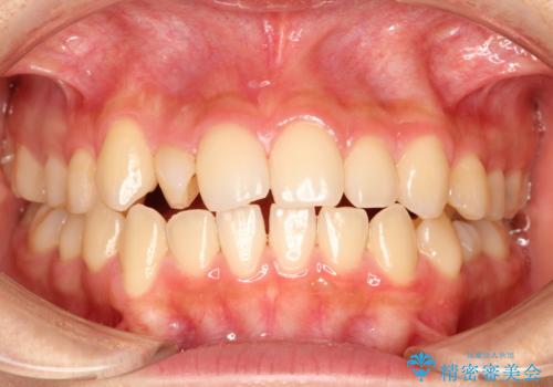 【ワイヤー矯正】インビザラインは途中でやめましたの症例 治療前