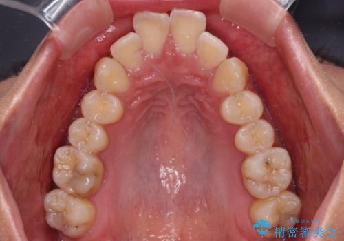 前に飛び出した上顎前歯をスッキリと引っ込める ワイヤー装置での矯正治療の治療前