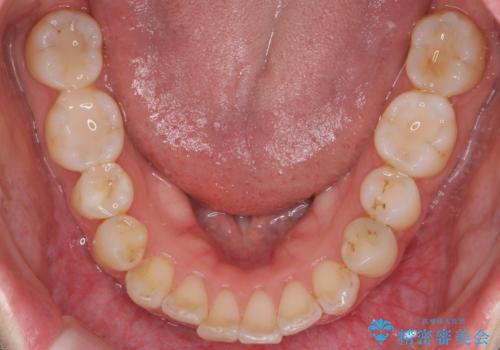 歯の着色を落としたいの治療後