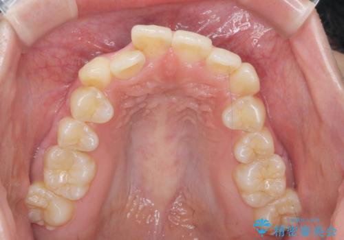 前歯のがたつきをマウスピース矯正できれいに!の治療前