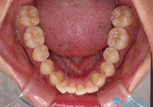前に飛び出した上顎前歯をスッキリと引っ込める ワイヤー装置での矯正治療の治療前