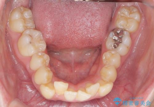 前歯のがたつきをマウスピース矯正できれいに!の治療前