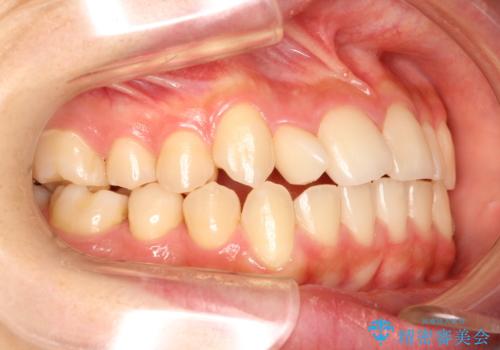 【ワイヤー矯正】インビザラインは途中でやめましたの治療前