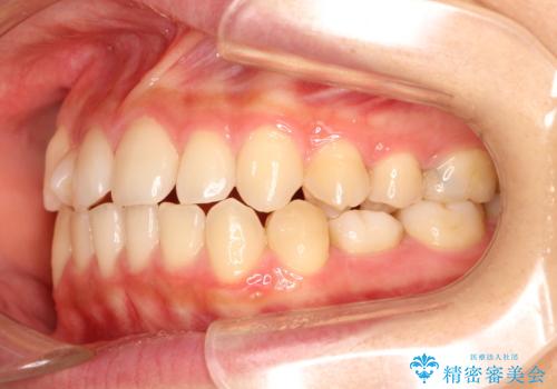 【ワイヤー矯正】インビザラインは途中でやめましたの治療前