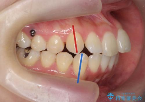 マイクロインプラントで達成する出っ歯の後方移動の治療中