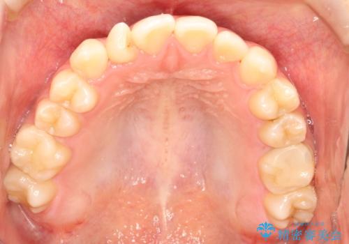 【ワイヤー矯正】インビザラインは途中でやめましたの治療前