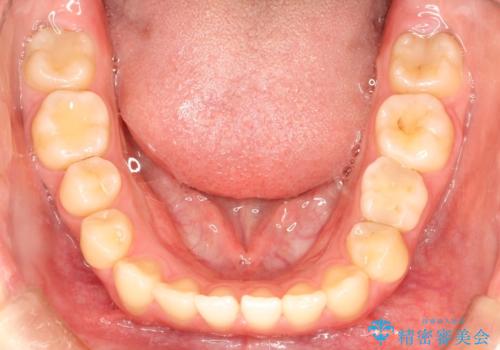 【ワイヤー矯正】インビザラインは途中でやめましたの治療前