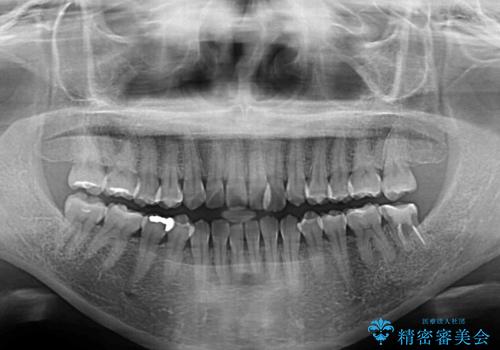 クロスバイトの前歯を改善 ワイヤー装置で楽々矯正治療の治療前
