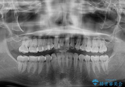 前歯のデコボコをインビザライン矯正で綺麗に改善の治療前