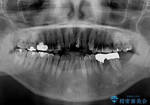 外科手術を検討? 過大な開咬をワイヤー装置とインビザラインで劇的に改善するの治療前