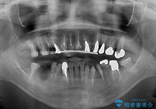 治療を開始したもののうまく噛めない 咬合改善のオールセラミック補綴治療の治療前