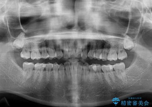 デコボコをワイヤー装置で改善 短期間で綺麗な仕上がりにの治療前