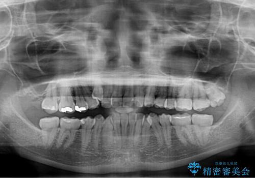 八重歯と正中のズレ ワイヤー装置での抜歯矯正の治療前