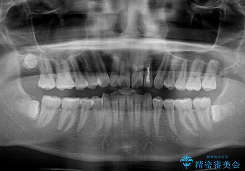 上顎前突とディープバイト ワイヤー矯正での確実に仕上げるの治療前