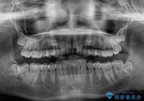前歯のデコボコを治したい インビザライン矯正治療の治療前