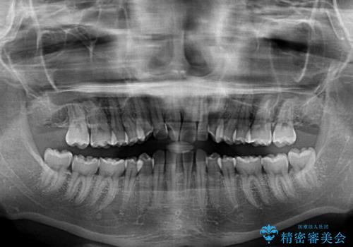 下顎前歯の欠損歯列　ワイヤー装置での矯正治療の治療前