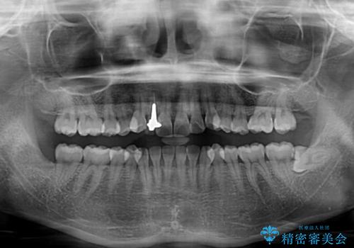 前歯のデコボコが気になる インビザラインによる矯正治療の治療前