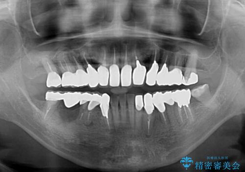 治療を開始したもののうまく噛めない 咬合改善のオールセラミック補綴治療の治療後