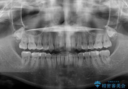 デコボコをワイヤー装置で改善 短期間で綺麗な仕上がりにの治療後
