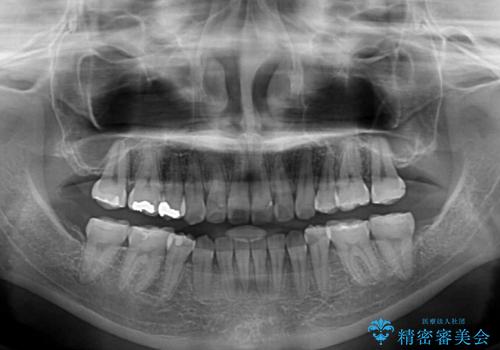 八重歯と正中のズレ ワイヤー装置での抜歯矯正の治療後