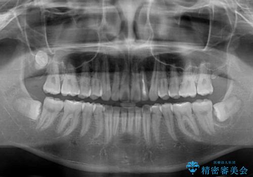 上顎前突とディープバイト ワイヤー矯正での確実に仕上げるの治療後