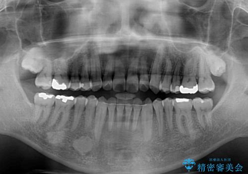 40代男性 今からでも遅くない インビザラインで綺麗な歯列を獲得の治療後