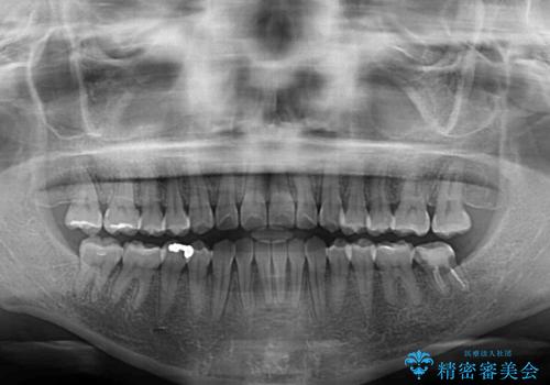 クロスバイトの前歯を改善 ワイヤー装置で楽々矯正治療の治療後