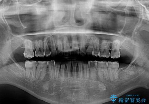 上下の八重歯とクロスバイト　ワイヤー装置での抜歯矯正の治療後