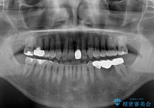 外科手術を検討? 過大な開咬をワイヤー装置とインビザラインで劇的に改善するの治療後