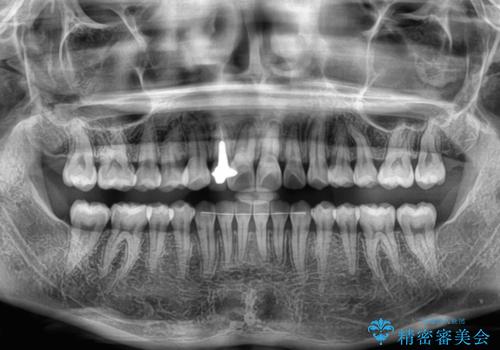 前歯のデコボコが気になる インビザラインによる矯正治療の治療後