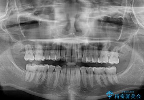 下顎前歯の欠損歯列 ワイヤー装置での矯正治療の治療後