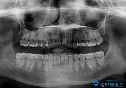 前歯のデコボコを治したい インビザライン矯正治療の治療後