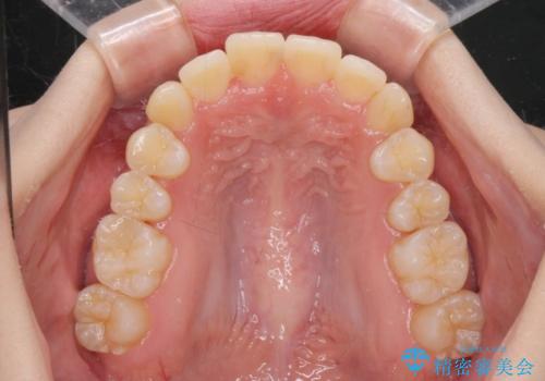 前歯のがたつきをマウスピース矯正できれいに!の治療後