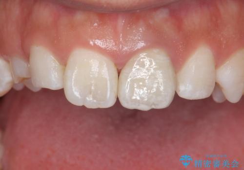 変色した前歯 ジルコニアクラウンでの修復の治療後