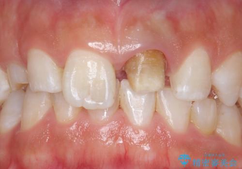 変色した前歯 ジルコニアクラウンでの修復の治療中