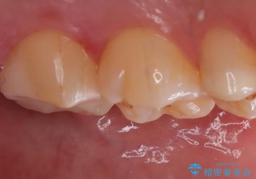【セラミックインレー】銀の詰め物を白くしたいの治療後