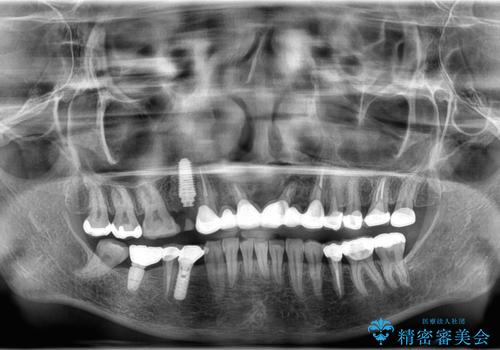 歯が折れている(1DAY インプラント)の治療後